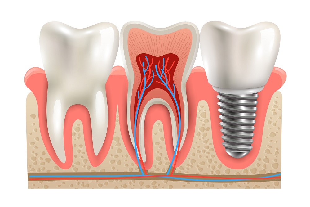 After Getting Dental Implants