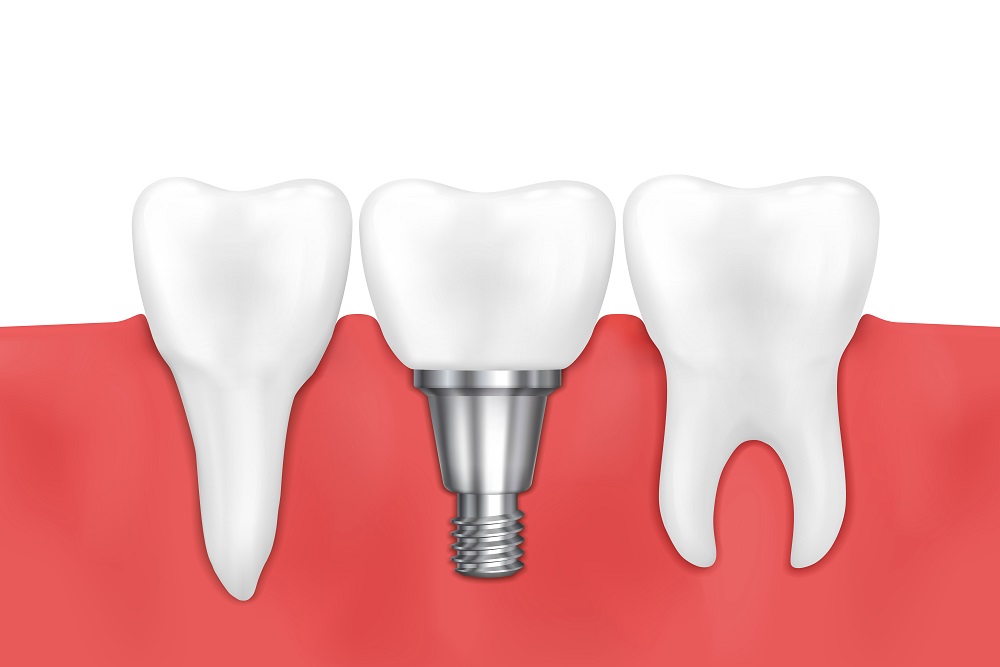 What to Expect After Getting Dental Implants