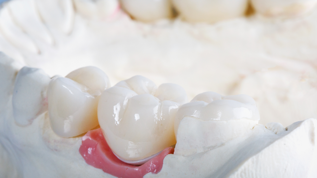 Close-up of dental crowns on a model showing tooth restoration and gum alignment