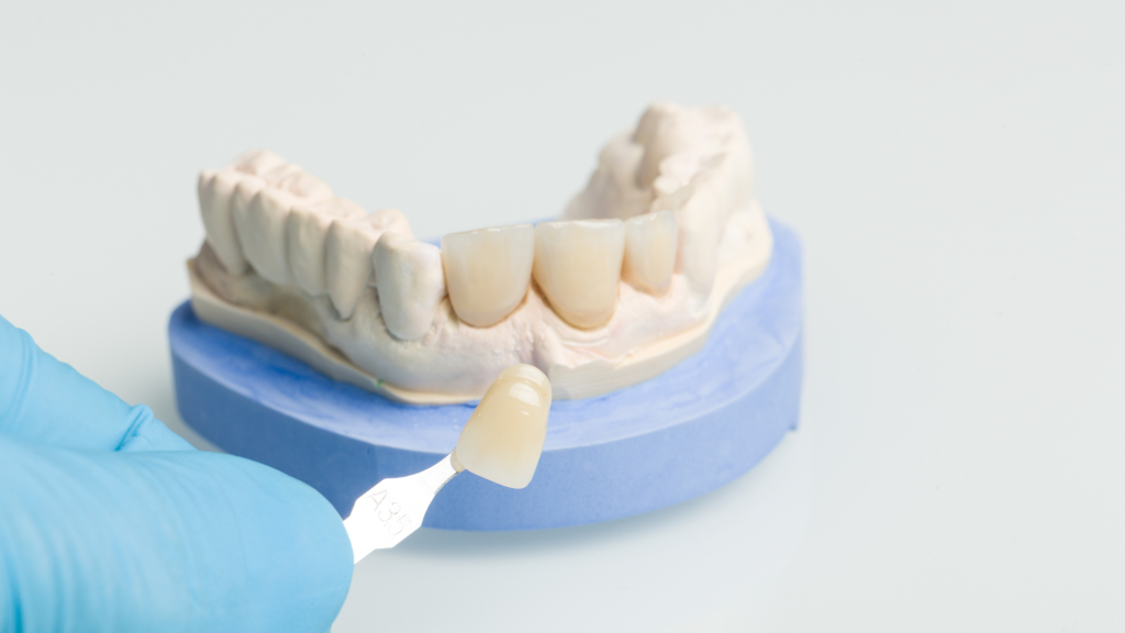 Dental professional matching a veneer to a tooth model during cosmetic dentistry procedure