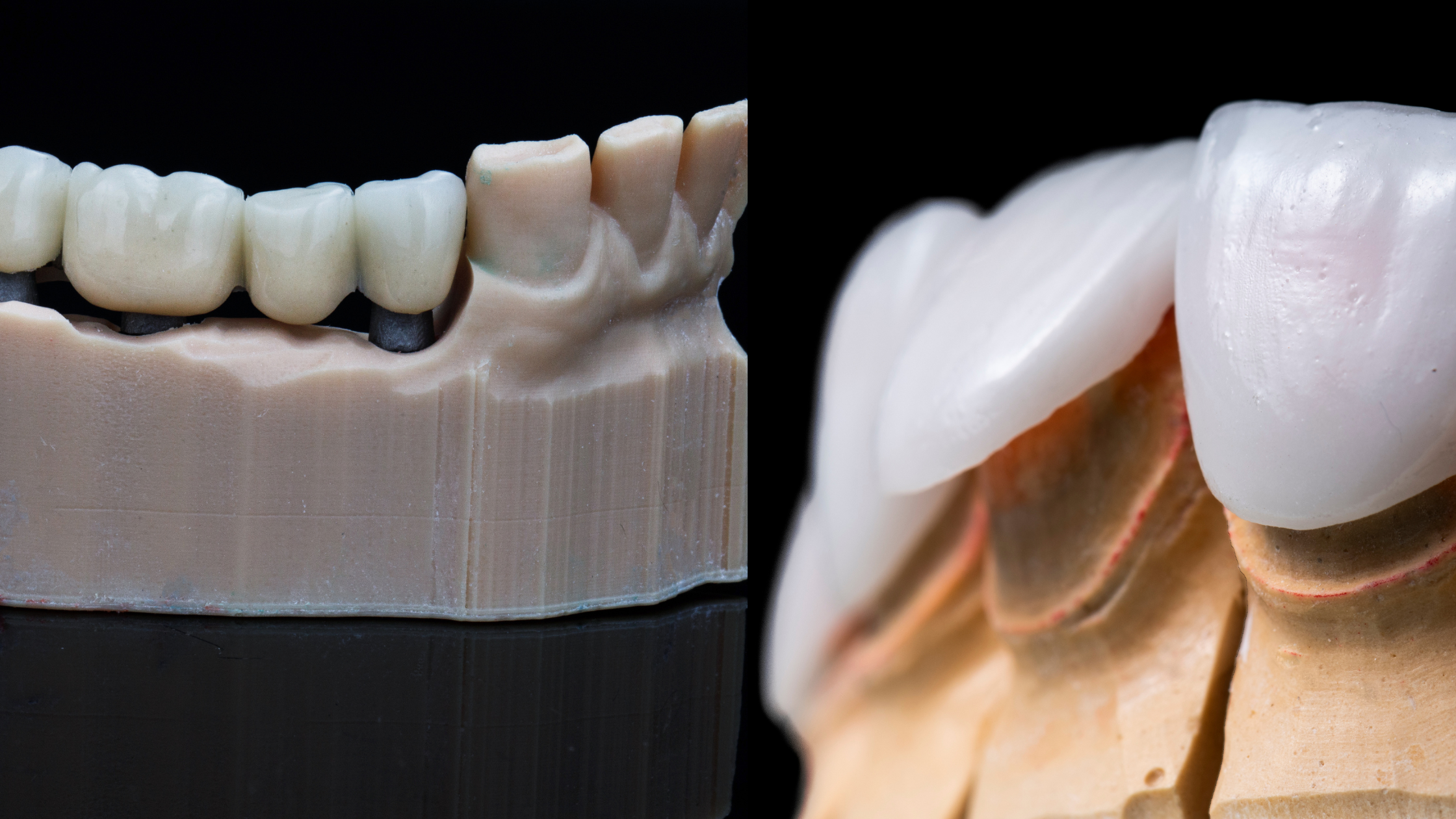 Side-by-side comparison of dental crowns and dental veneers on dental models