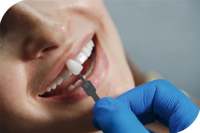 U-Smile Dental Club | Veneers or Whitening? Choosing the Best Cosmetic Option in Sydney U-Smile Dental Club | Veneers or Whitening? Choosing the Best Cosmetic Option in Sydney