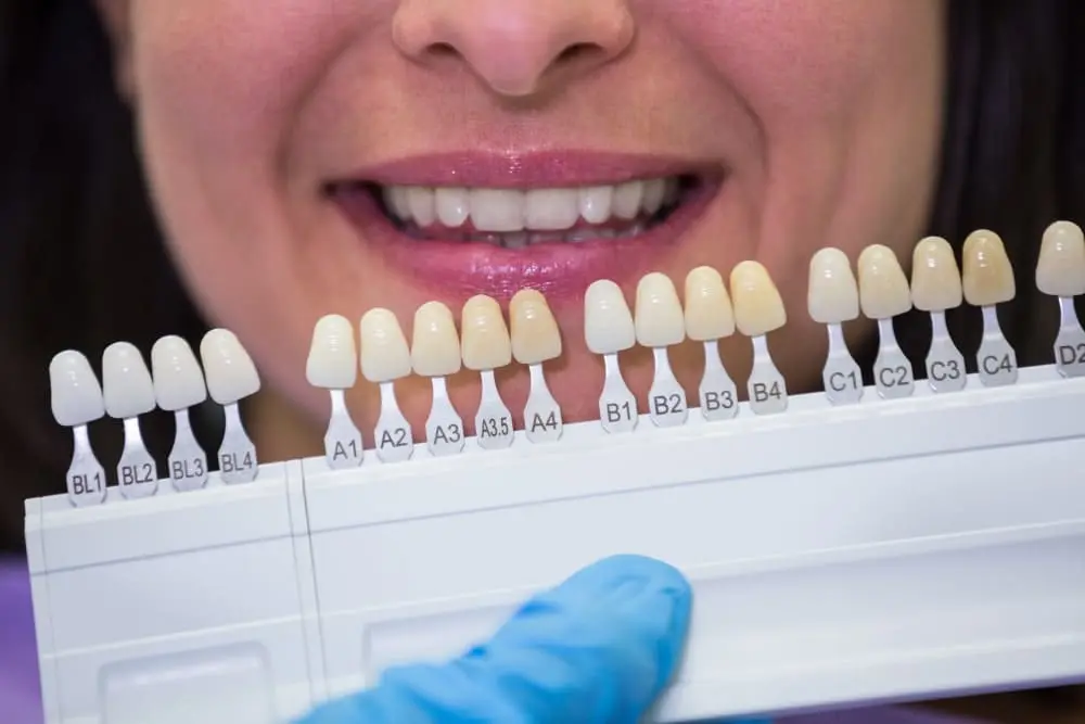 Care-for-Dental-Veneers